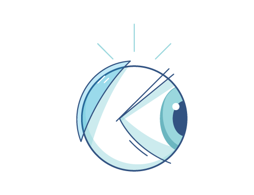 Illustration d'une lentille de contact derrière un globe oculaire.