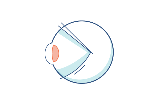 Illustration of an eye with presbyopia